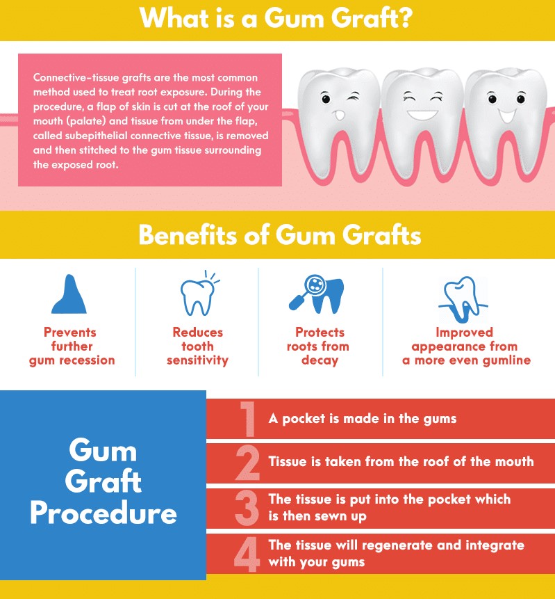 4 Ways Gum Grafting Improves Your Smile | Michael Stypula, DDS